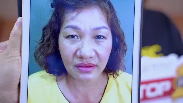 Mắt sụp mí già nua vị khách hàng quyết định nâng cung mày + cắt mí trên + cắt mí dưới để lấy lại 5 năm thanh xuân