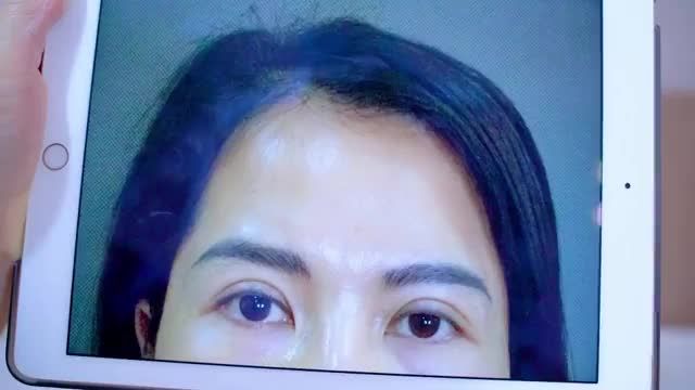 Dr.Hải Lê số 1 phẫu thuật sửa mí lỗi hỏng giải cứu giúp khách hàng lấy lại đôi mắt đẹp tự tin rạng rỡ