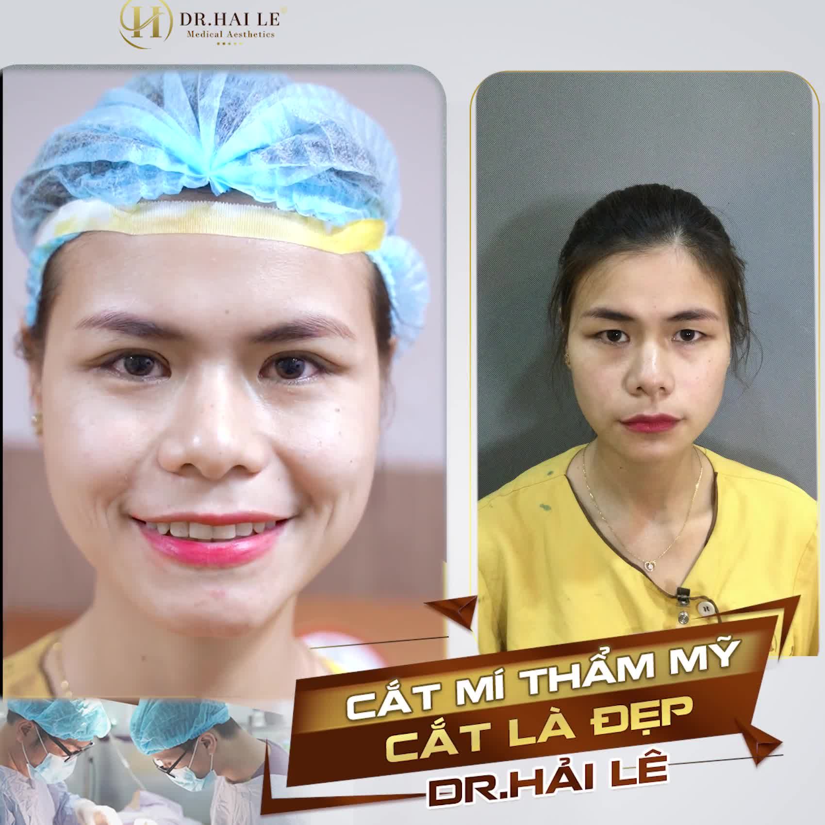 Nhiều khách hàng chia sẻ: “Chỉ cần có ý định làm mí thì không cần suy nghĩ mà đến ngay Dr.Hải Lê”