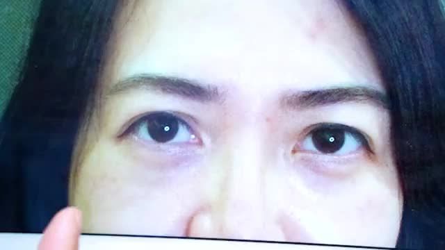 Sụp mí tuổi ngoài 35++ phải làm sao? Mời quý khách hàng cùng theo dõi tại video này!