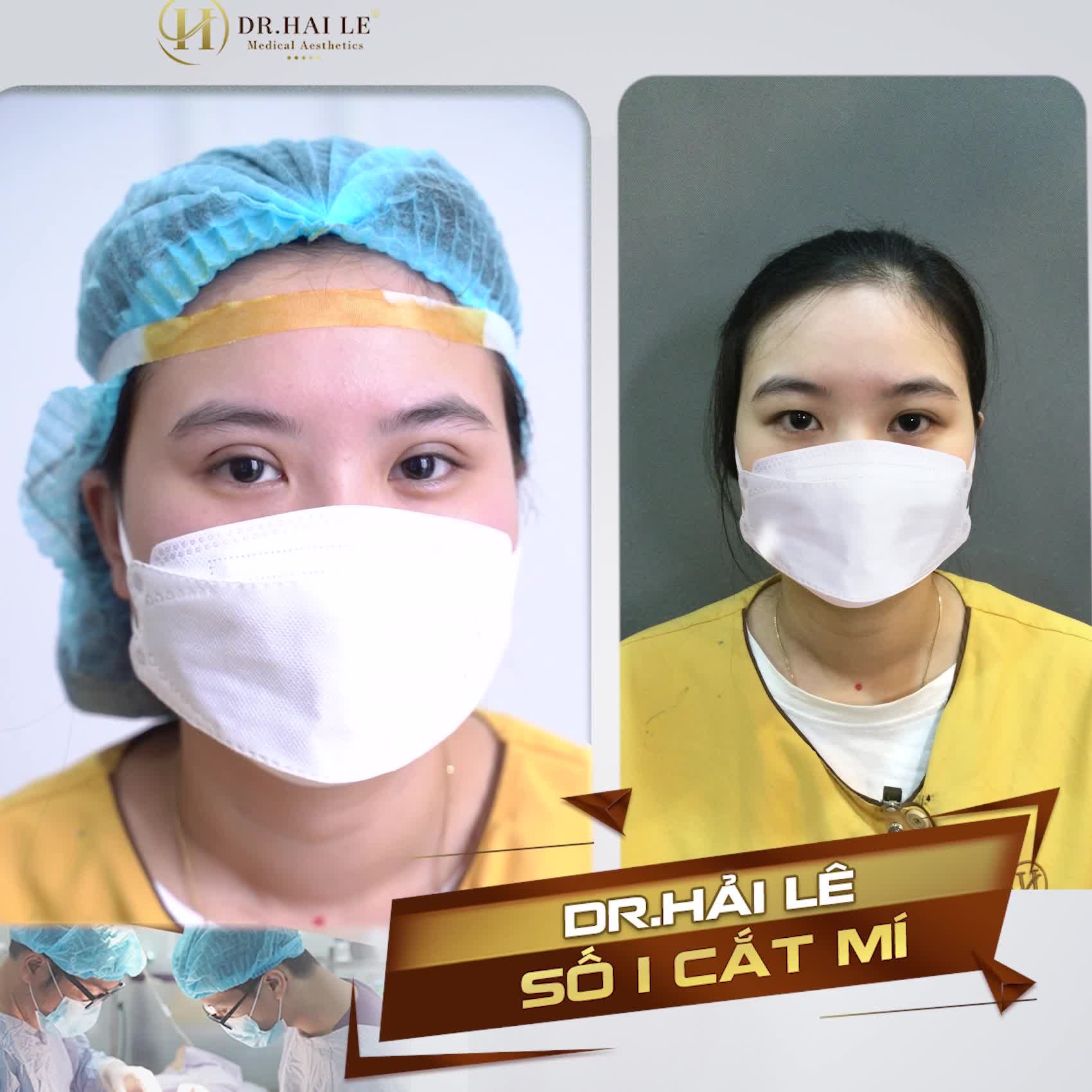 Lại 1 cực phẩm cắt mí tại Dr.Hải Lê hôm nay đây ạ!