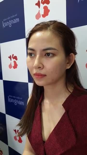 10 ngày sau Nâng mũi S-Line tại Kangnam, kết quả bất ngờ ra sao? Lột xác đâu xa, chỉ cần nâng mũi