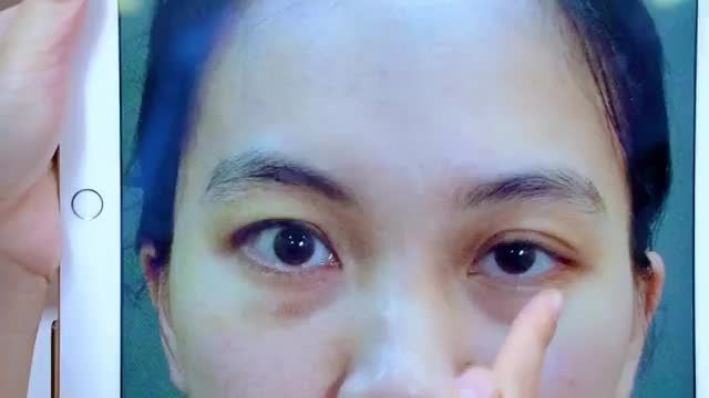 Sụp mí bẩm sinh có chữa được không? Cùng theo dõi qua video này bạn nhé