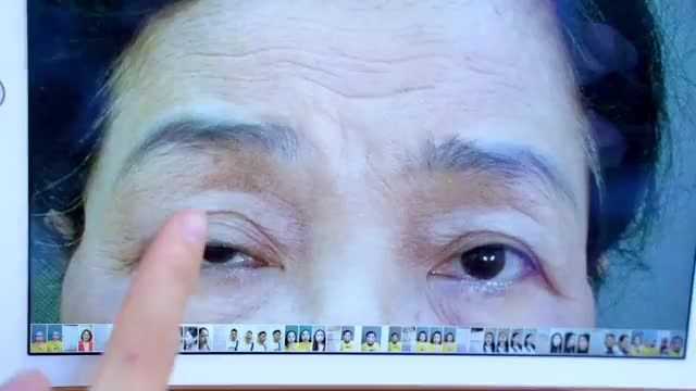 Sụp mí bẩm sinh có phải phương pháp nào cũng có thể thực hiện thành công? Theo dõi ngay video sau đây