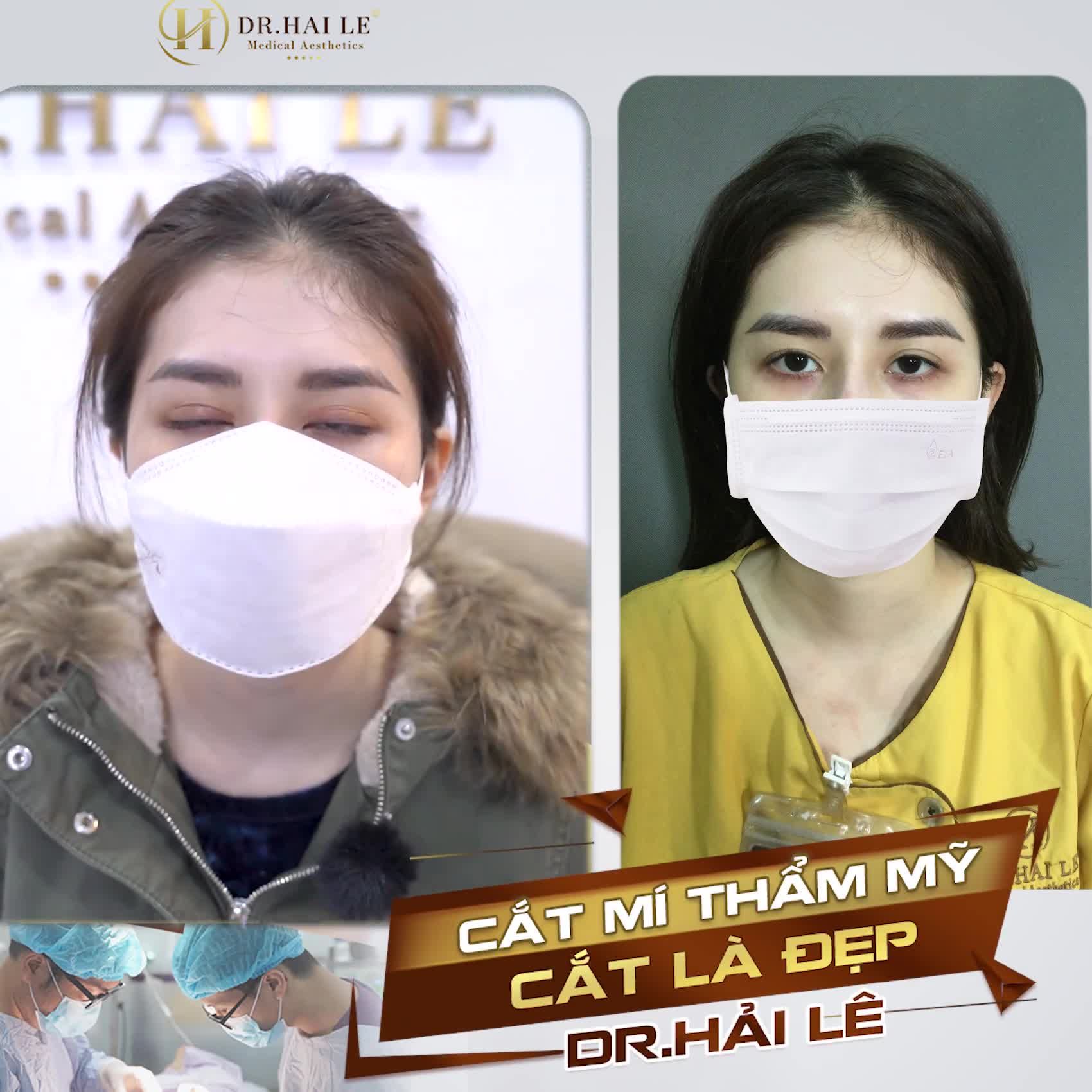 Quyết định đi cắt mí khi nghe bạn bè review về Dr.Hải Lê