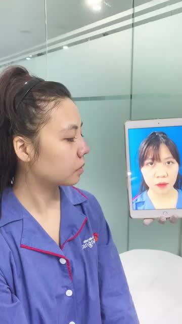 Đầu mũi to - da mũi dày - mũi ngắn, hớt… phải làm sao??? Cùng theo dõi livestream kết quả nâng mũi cấu túc 4D tại Kangnam để thấy sự khác biệt