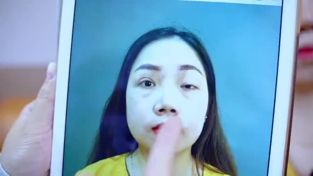 Dr.Hải Lê số 1 phẫu thuật chỉnh hình mí sụp bẩm sinh có thể giúp bạn cải thiện tình trạng này như thế nào?