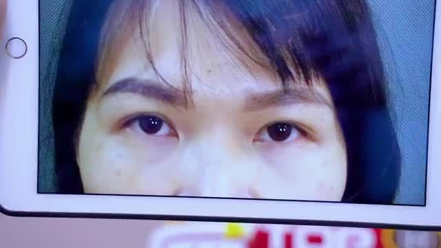 Mắt đẹp thế này sau phẫu thuật mí tại Dr.Hải Lê vị khách hàng vỡ òa vì hạnh phúc