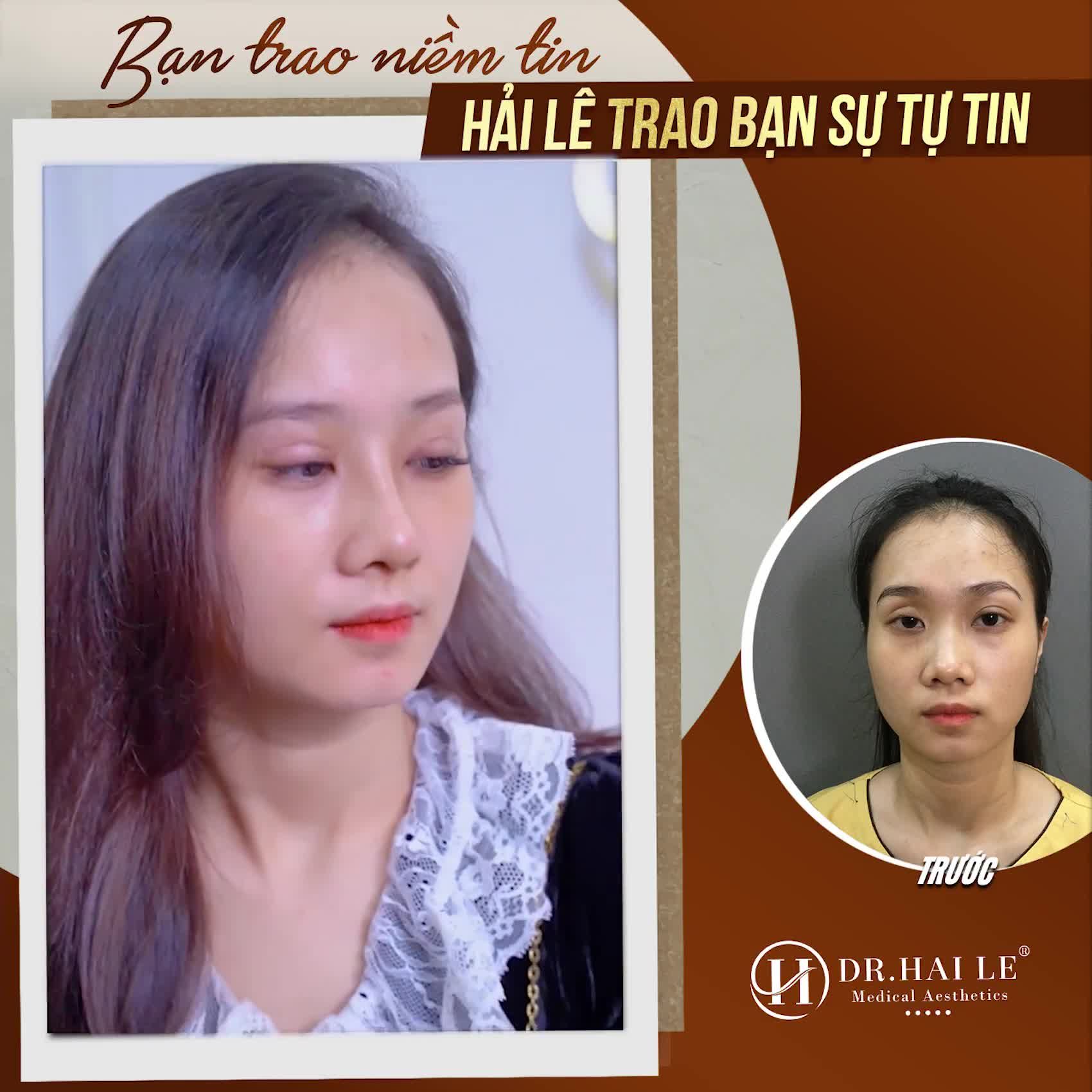 Chỉ vì nghe được NHỮNG CƠN MƯA LỜI KHEN mà em đã tìm tới Dr.Hải Lê để thực hiện Sửa mí Nâng mũi