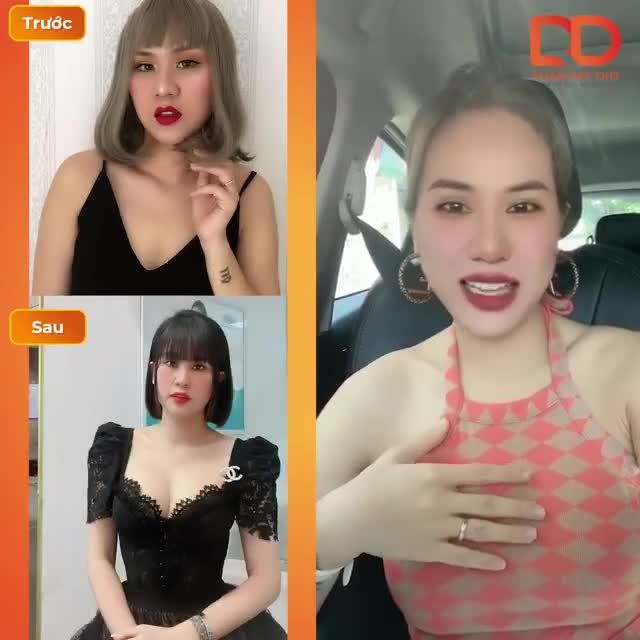 Lại tiếp tục chuỗi "series" chia sẻ kinh nghiệm khi thực hiện phẫu thuật Nâng V1 Harmonic của cô nàng Ngọc Anh.
