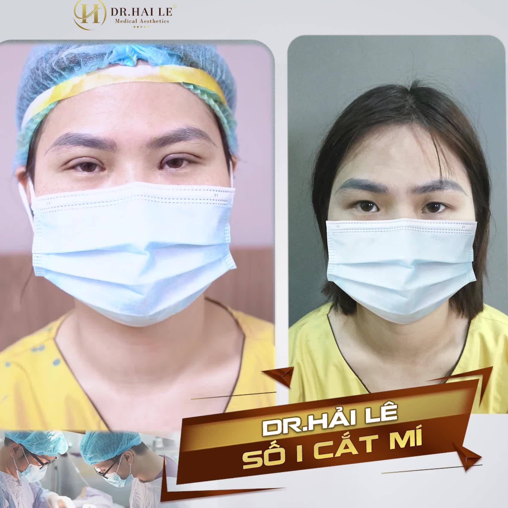 Bạn ấy nói: "Quyết định đi cắt mí khi nghe bạn bè review về Dr.Hải Lê"