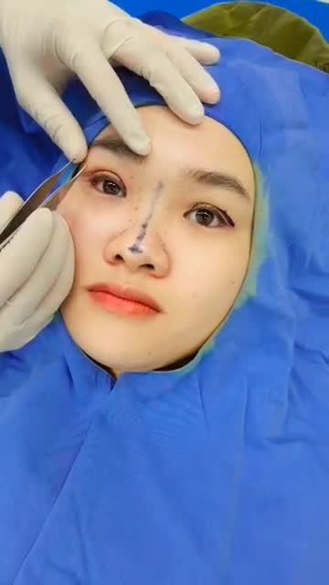Thử thách so sánh 1 bên mắt đã cắt mí và 1 bên mắt tự nhiên