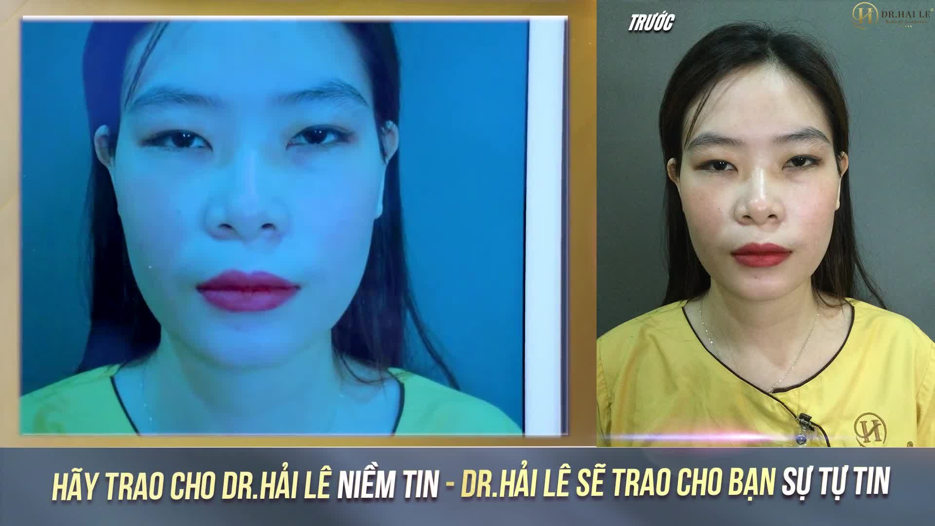 Từ nhỏ mắt em đã bé ti hi, không rõ nếp mí, góc rẽ quạt sâu. Ai gặp cũng hỏi đúng một câu: Em có chuyện gì buồn ah!