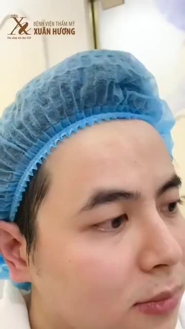 KHÁCH HÀNG NAM NÂNG CƠ THERMAGE 4.0 FLX, KẾT QUẢ KHÁC BIỆT KHI LÀM TRƯỚC 1 BÊN MẶT