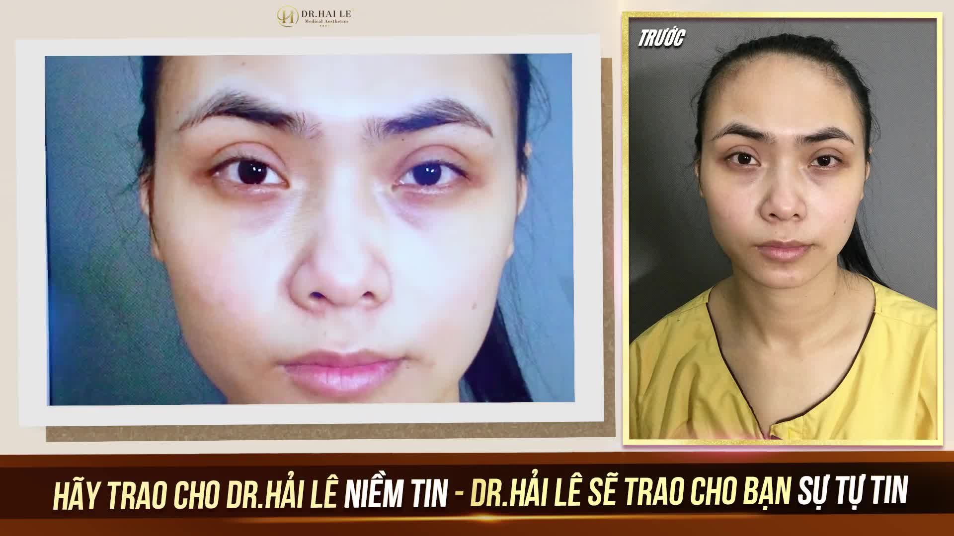 Trời ơi! cắt mí đã 3 năm tại cơ sở khác rồi nhưng nếp mí cực kì to, chờ đợi hoài chờ mãi mà nó không tự nhiên đi chút nào!