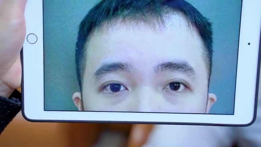 Nhược cơ nâng mi bẩm sinh được khắc phục như thế nào tại Dr.Hải Lê? Mời quý khách hàng cùng đón xem