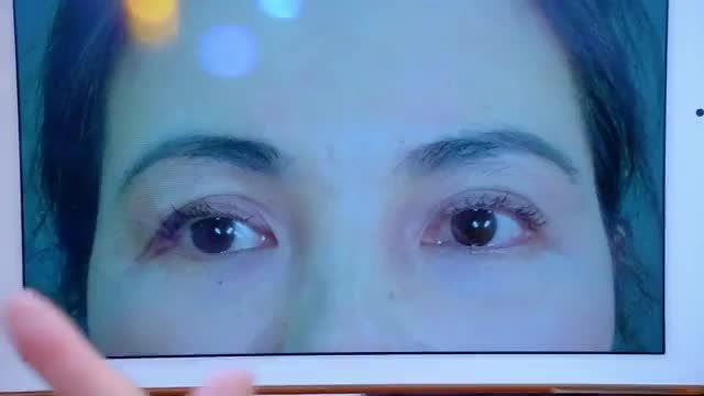 Sửa mí sau 7 ngày thực hiện vẫn còn sưng nhưng kết quả đã cải thiện rất nhiều