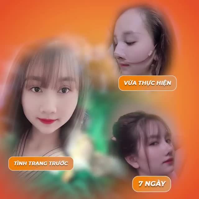 Ai nói mũi nâng càng lâu càng tụt? Hãy để nâng mũi Perfect Dform chứng minh rằng dù trải qua nhiều thời gian, dáng mũi vẫn đẹp như lúc ban đầu.