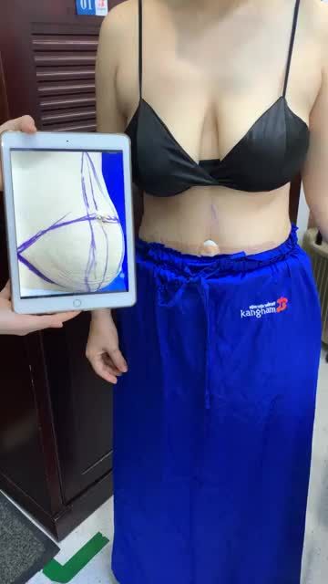 Biển đổi vòng eo chảy xệ sau sinh em bé thành vòng eo thon gọn mượt mà