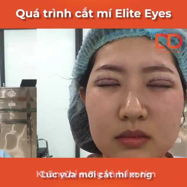 Cắt mí xong cứ thấy nếp mí: Vừa GIÀ, vừa GIẢ, mắt lại còn DẠI DẠI