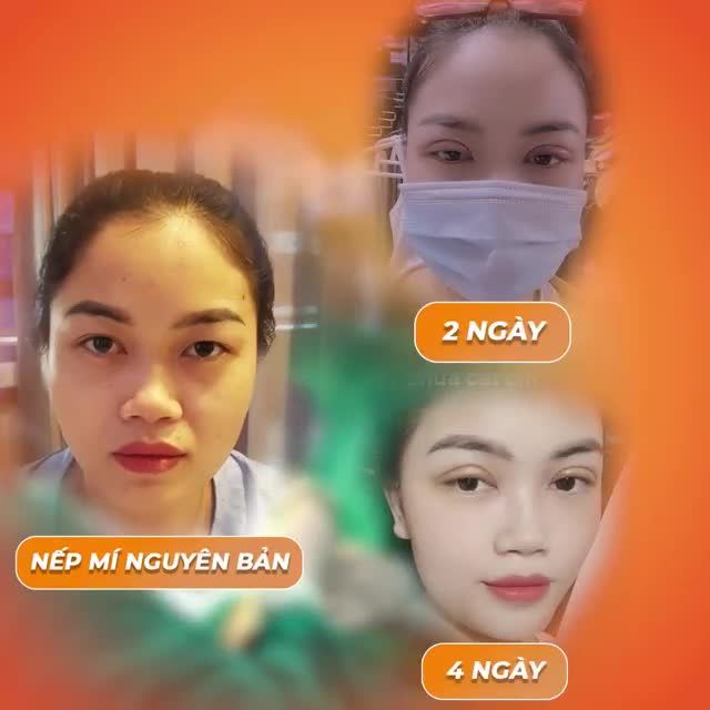 Nếu nàng hỏi Cắt mí Elite Eyes có đáp ứng đủ các tiêu chí: