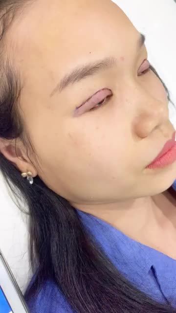 Thăng hạng nhan sắc sau khi cắt mí Plasma Hàn Quốc