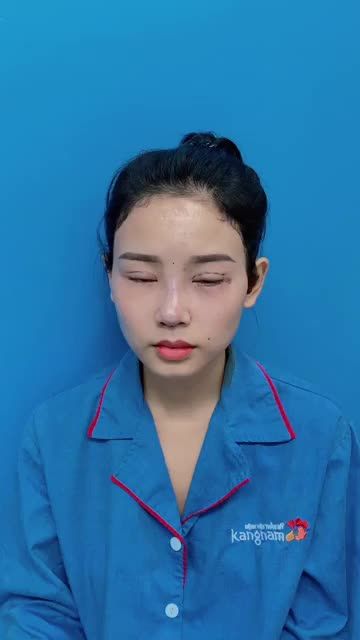 Hoá hot girl sau khi làm combo nâng mũi cắt mí tại BVTM KANGNAM