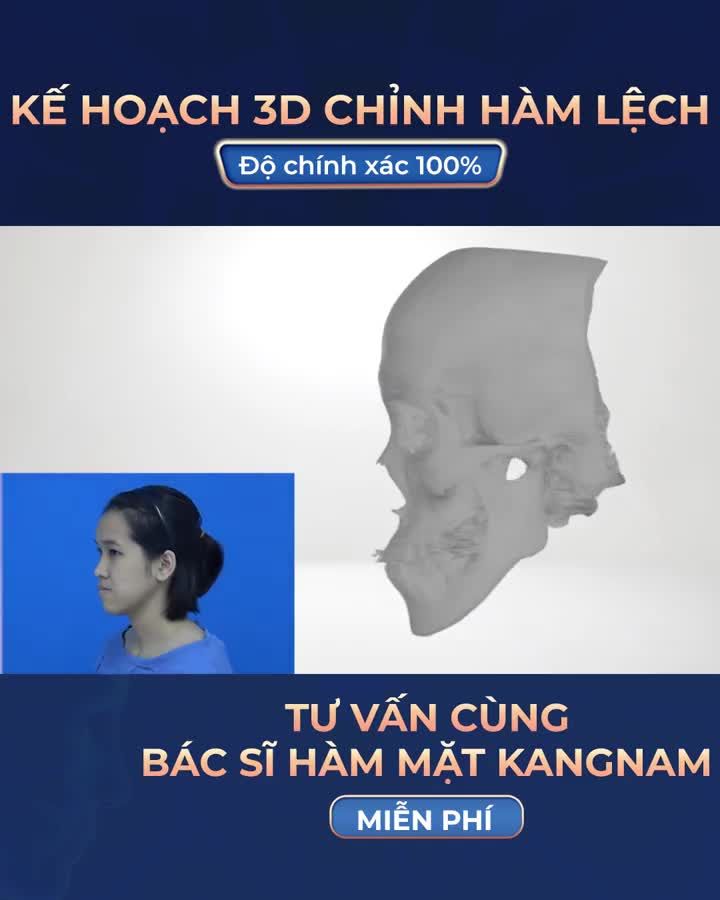 Công nghệ 3D: Mô phỏng Lập kế hoạch phẫu thuật chỉnh hàm lệch