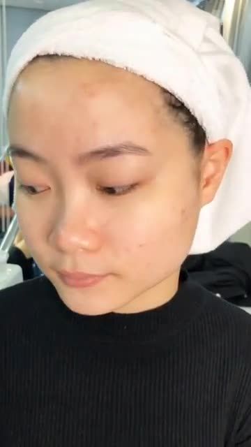 Thời điểm vàng để điều trị mụn bắt đầu từ bây giờ đến cuối năm để kịp đón tết rồi ạ