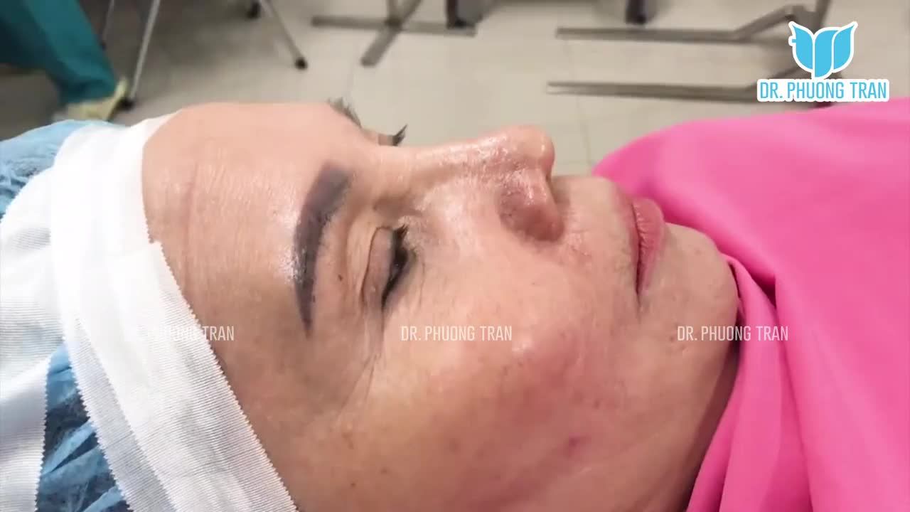 MỘT CHIẾC MŨI SỤN SƯỜN 14 NGÀY QUÁ ĐẸP