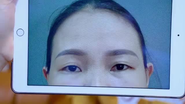 Mắt sụp mí "hô biến" thành 2 mí trẻ trung rõ nét chỉ sau 30 phút