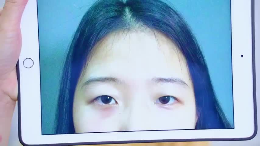 Mắt 1 mí nhược cơ u buồn phải làm sao