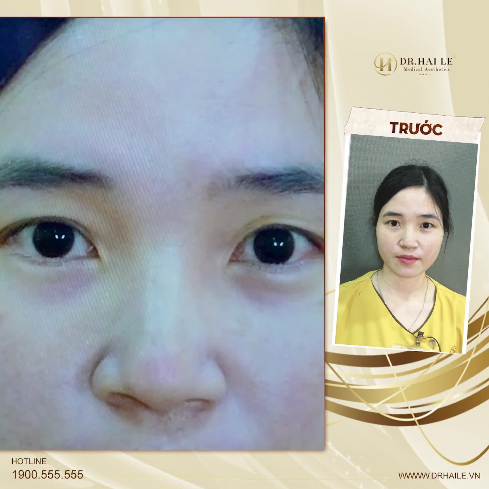 Em biết Dr.Hải Lê qua bác em, thấy bác làm đẹp quá nên em đã quyết định tới đây.