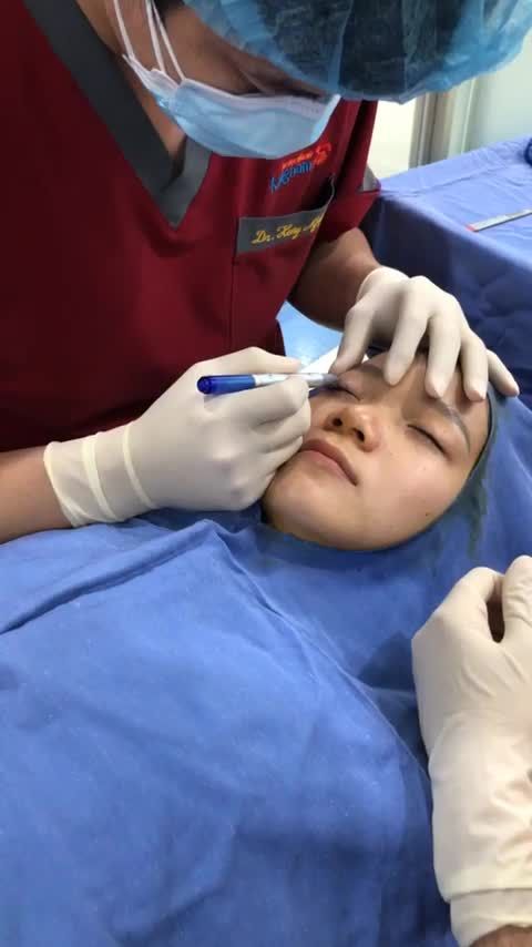 Quy trình đo vẽ bấm mí tại Bệnh viện thẩm mỹ Kangnam