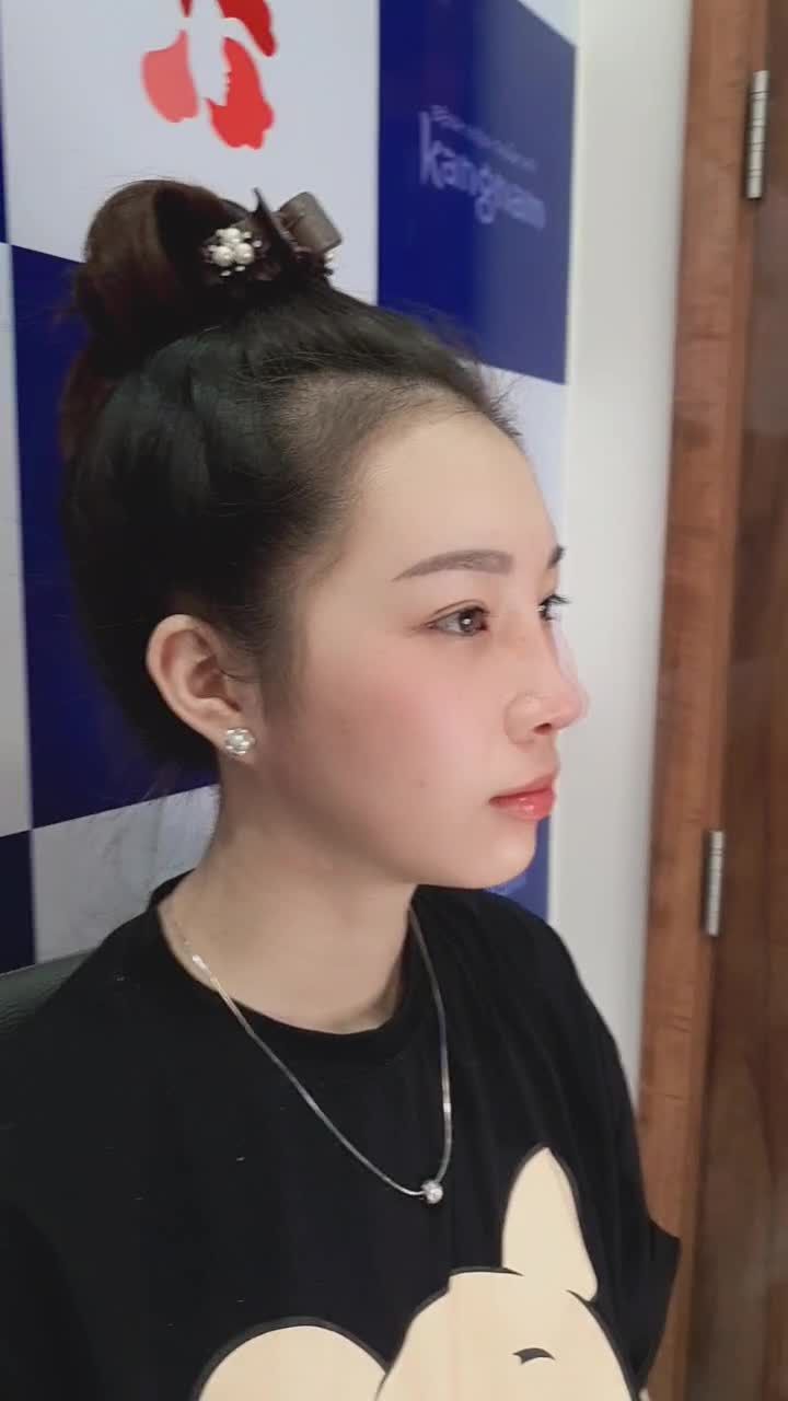 Kết quả chị khách hàng thực hiện combo nâng mũi + cắt mí tại Kangnam 666 Cách Mạng Tháng 8 nhé!