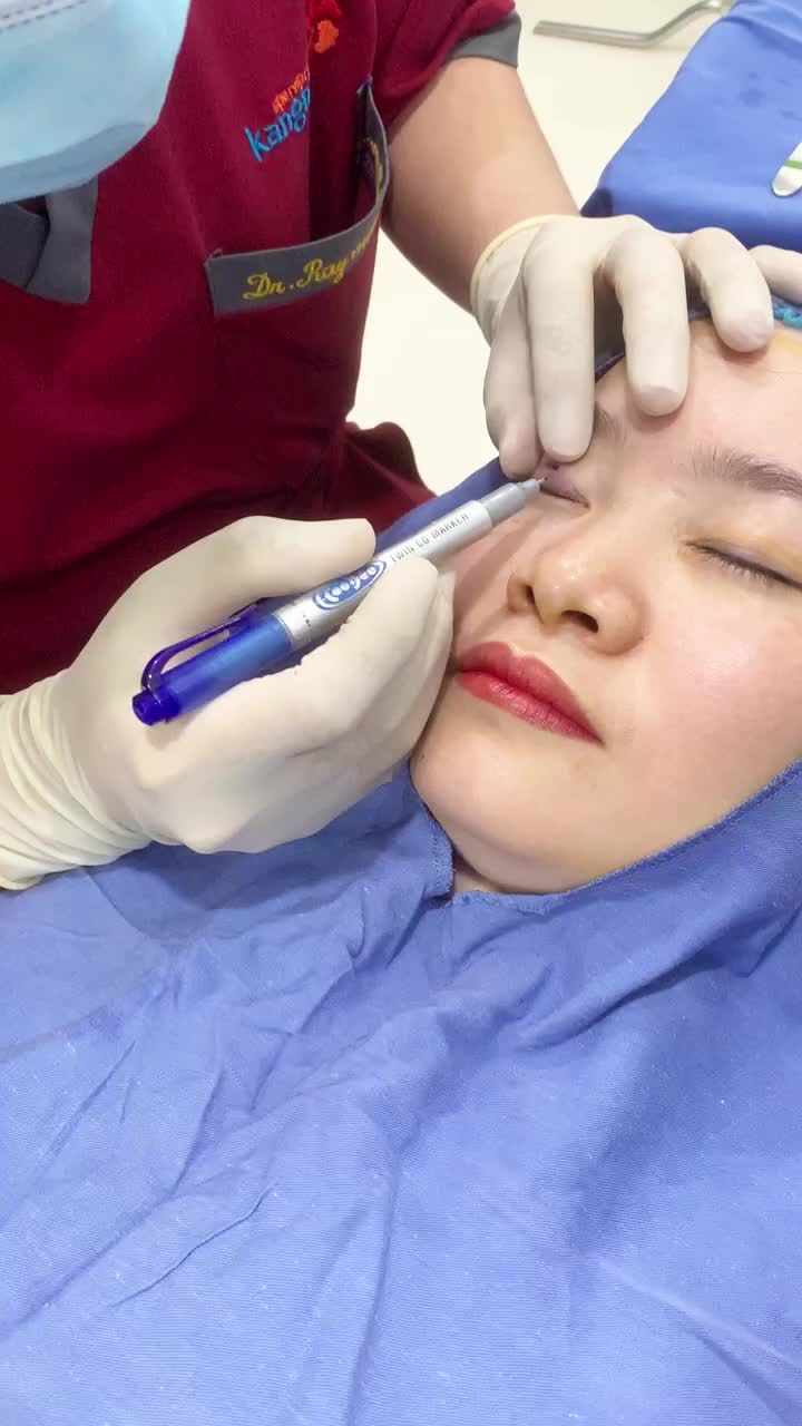 Đo vẽ cắt mí Plasma, trẻ hóa hoàn toàn đôi mắt