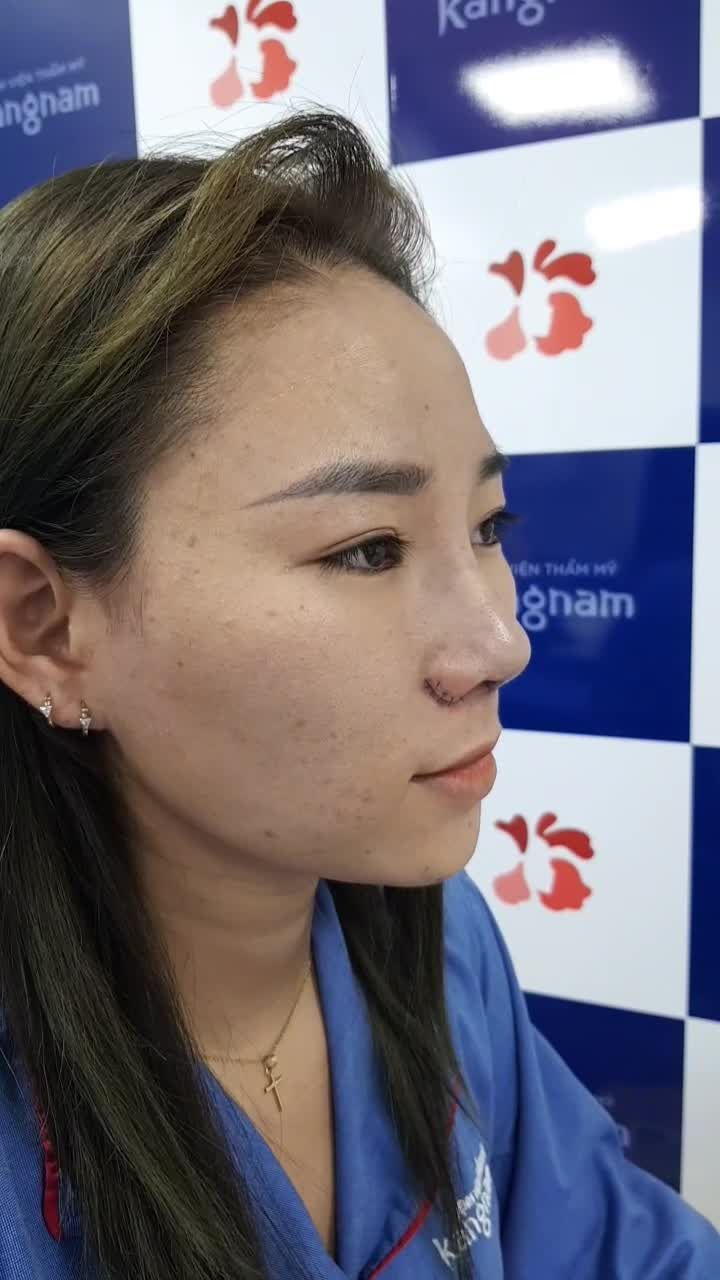 Nâng mũi + cắt cánh mũi - bộ đôi cho mũi thon đẹp như gái Hàn đây chị em ơi