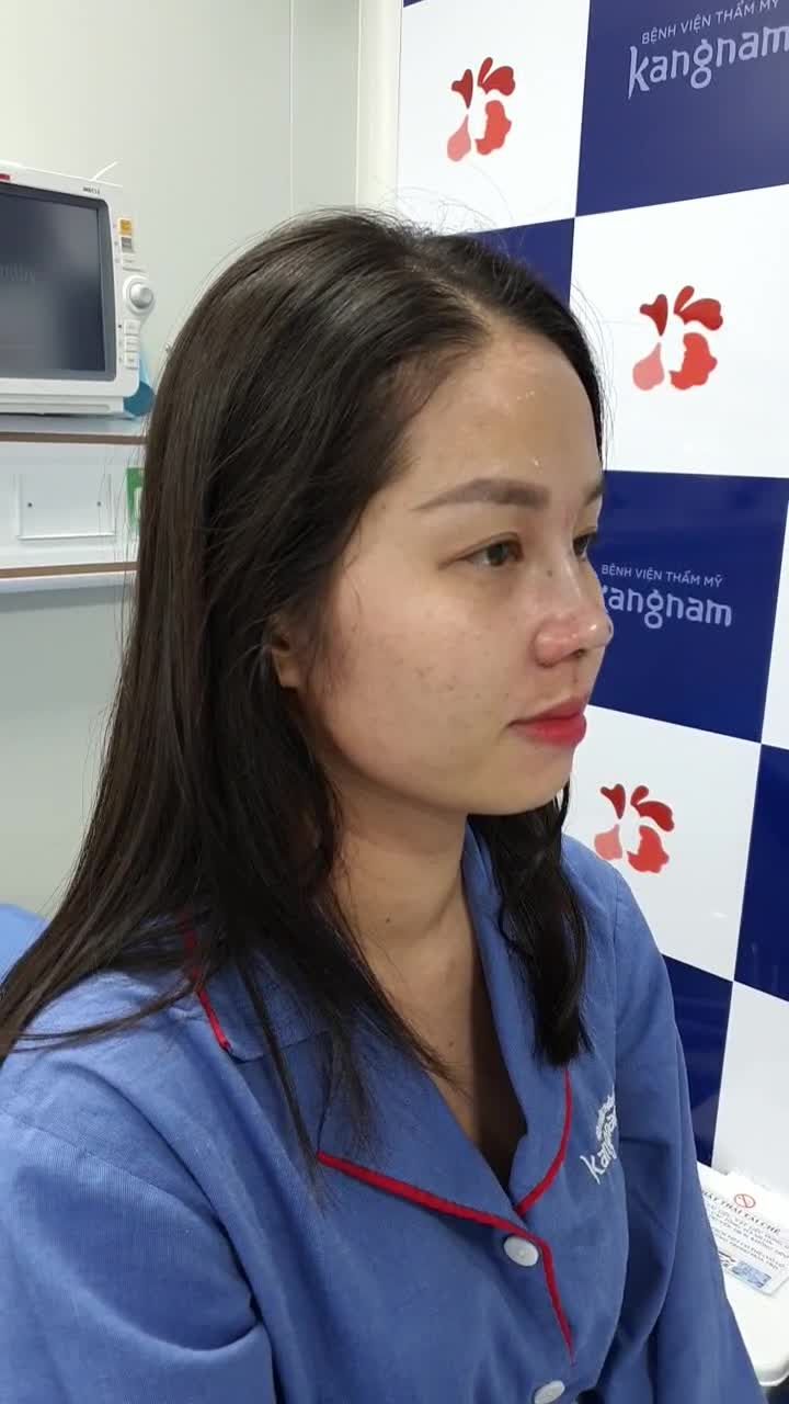 Cô gái trẻ trung làm đẹp đón tết với combo nâng mũi + cắt cánh mũi