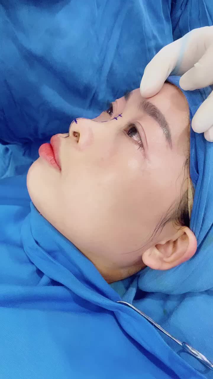 Quá trình Nâng mũi cấu trúc 4D tại Bệnh viện Thẩm Mỹ Kangnam