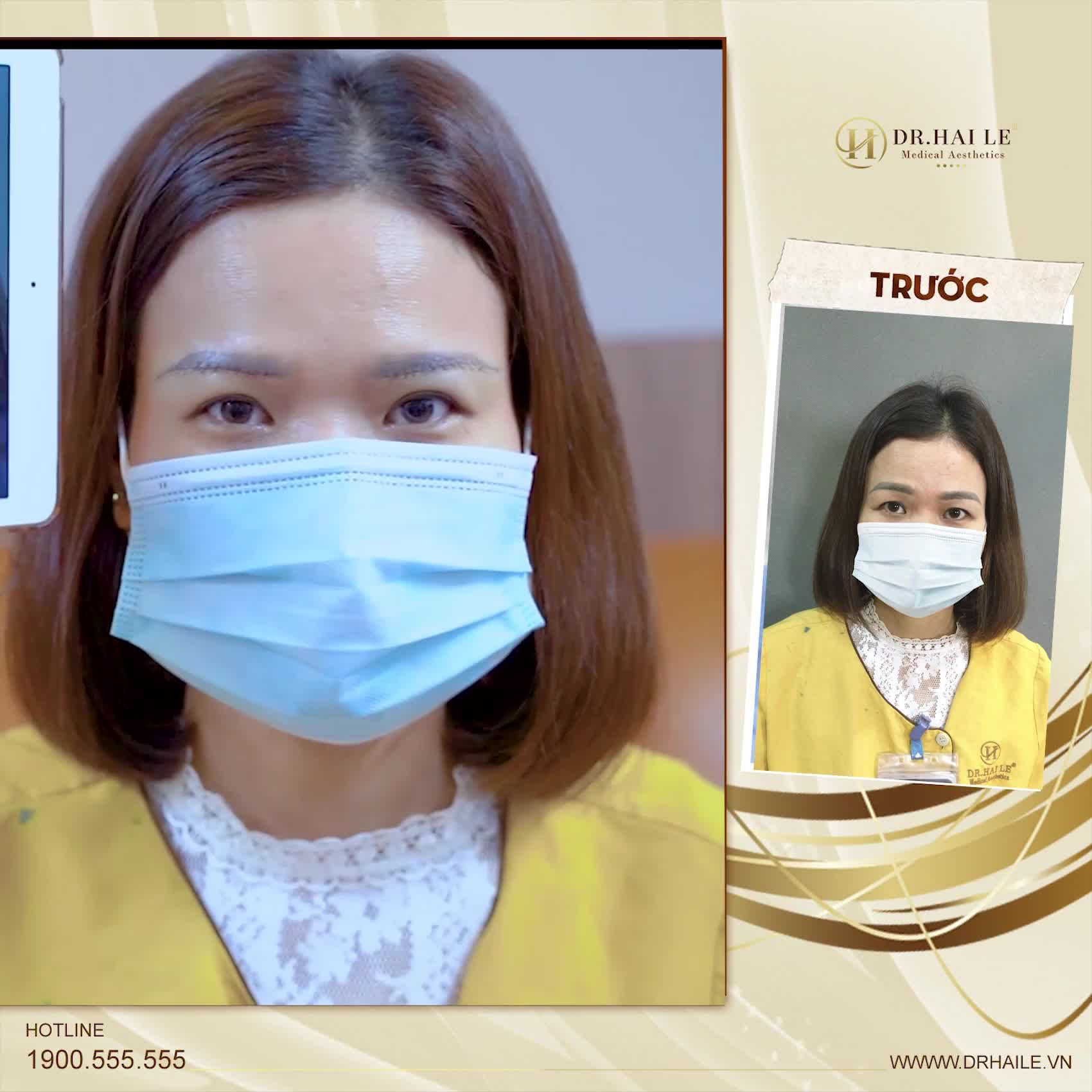 Dr.Hải Lê hỏi chị ấy Chị có cảm thấy HỐI HẬN sau khi thẩm mỹ mắt tại Dr.Hải Lê không