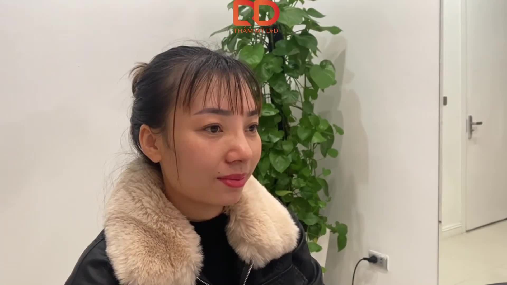 Nâng mũi Perfect Dform, thu 1 chút cánh mũi, nghe có vẻ đơn giản nhưng hiệu quả mang lại bất ngờ đấy cả nhà ạ.