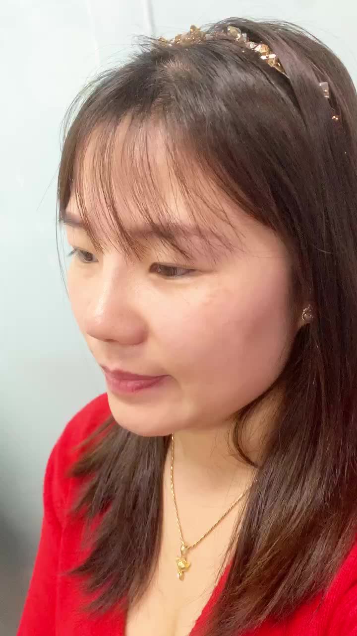 Mũi đẹp cao tây sau 10 ngày phẫu thuật nâng mũi Cấu trúc 4D tại Kangnam