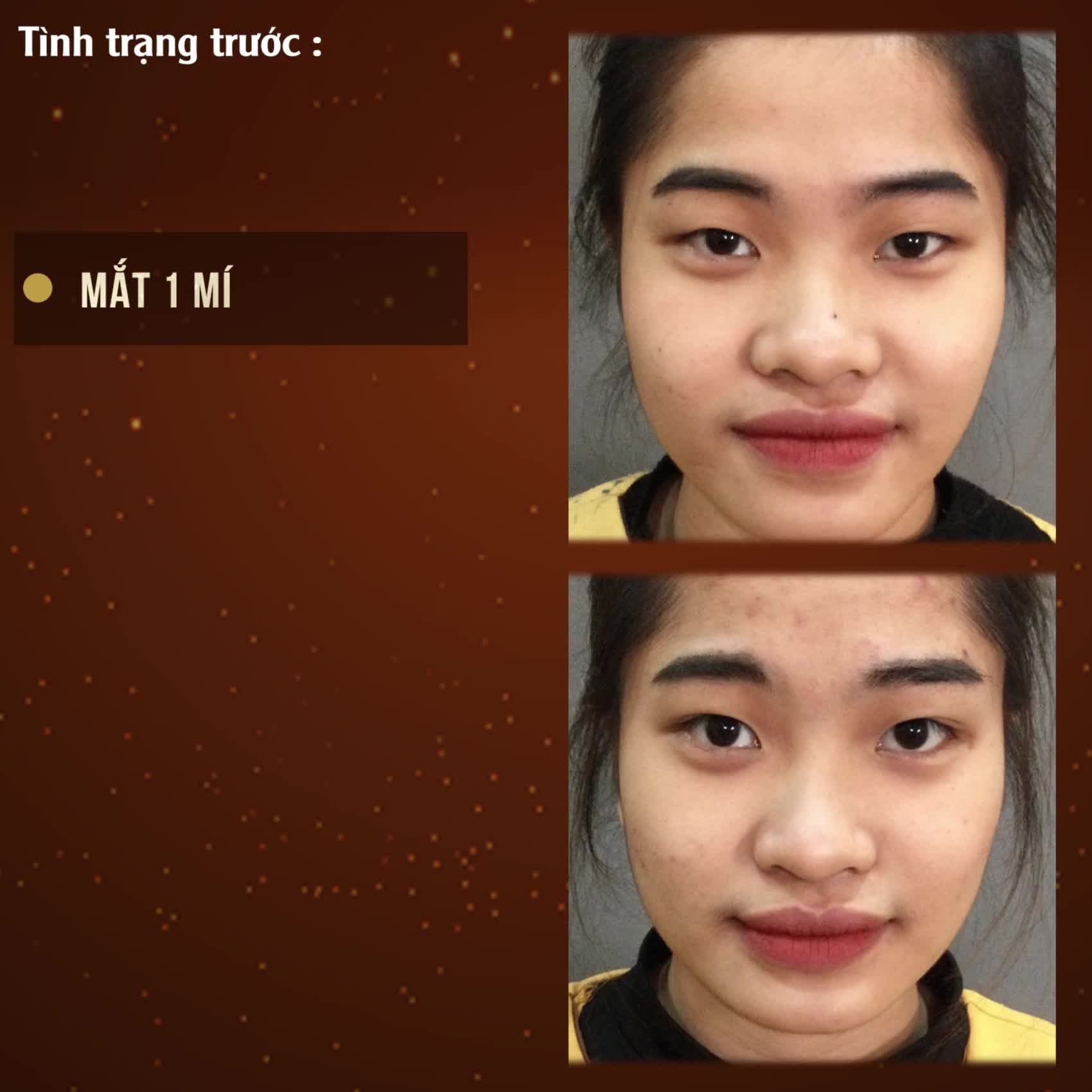 Vẫn là chúng mình nhưng đã xinh hơn rất nhờ cắt mí tại Dr.Hải Lê!