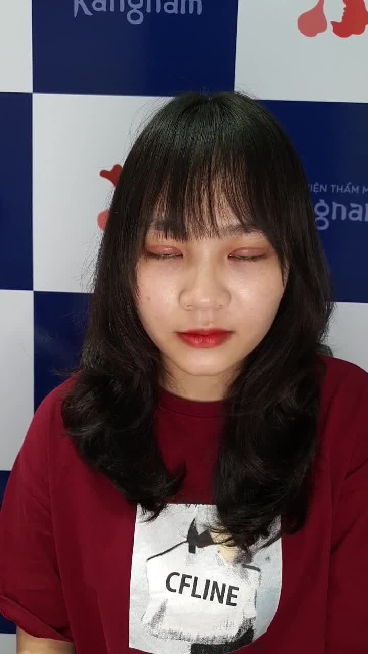Ai nói Cắt mí (thay đổi nhỏ) không lột xác được
