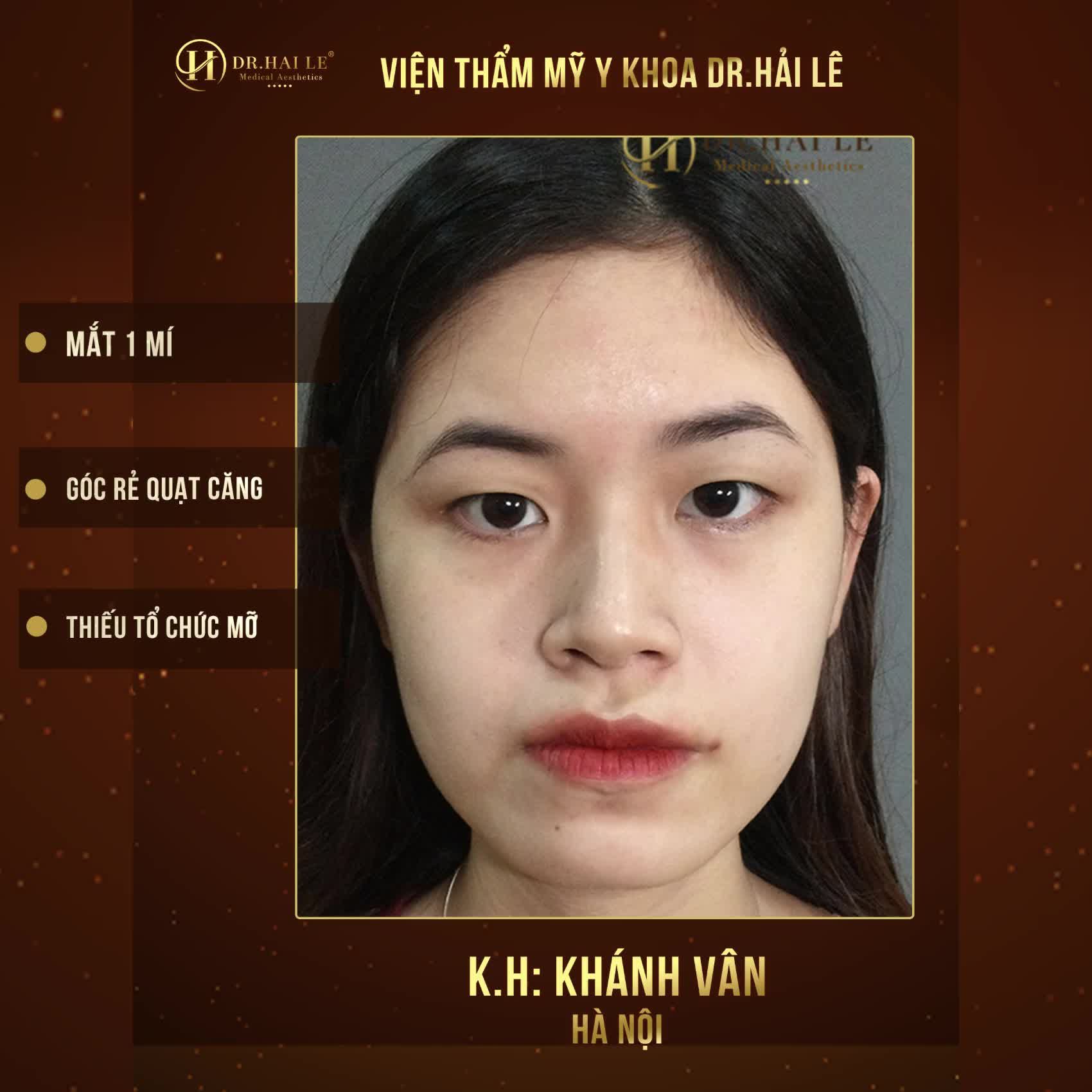 Mí lót hoá hai mí Nếp mí bền đẹp tự nhiên