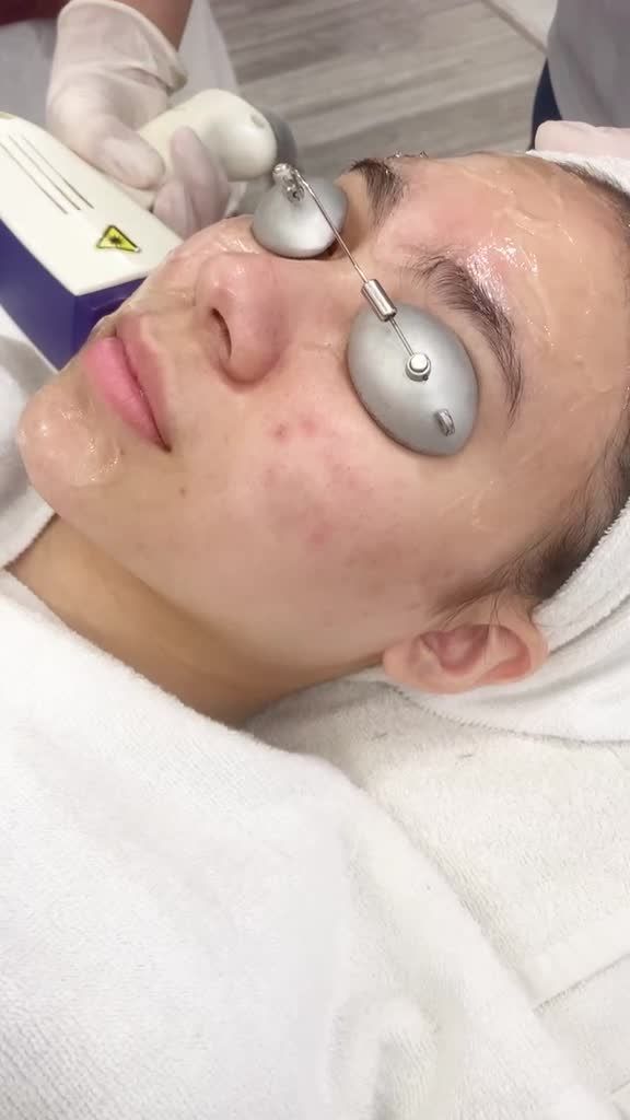 Kết quả triệt lông mặt tại Kangnam Hà Nội