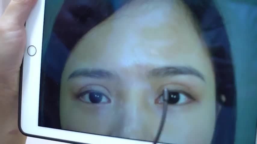 Tranh thủ đi sửa mí để nhẹ gánh nặng stress vì mí lỗi hỏng trước Tết