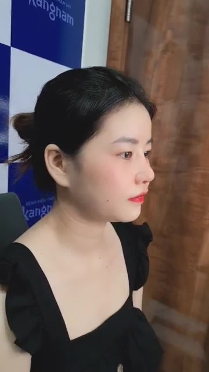 Dáng mũi đẹp xuất sắc sau khi thực hiện nâng mũi sụn sườn 100%