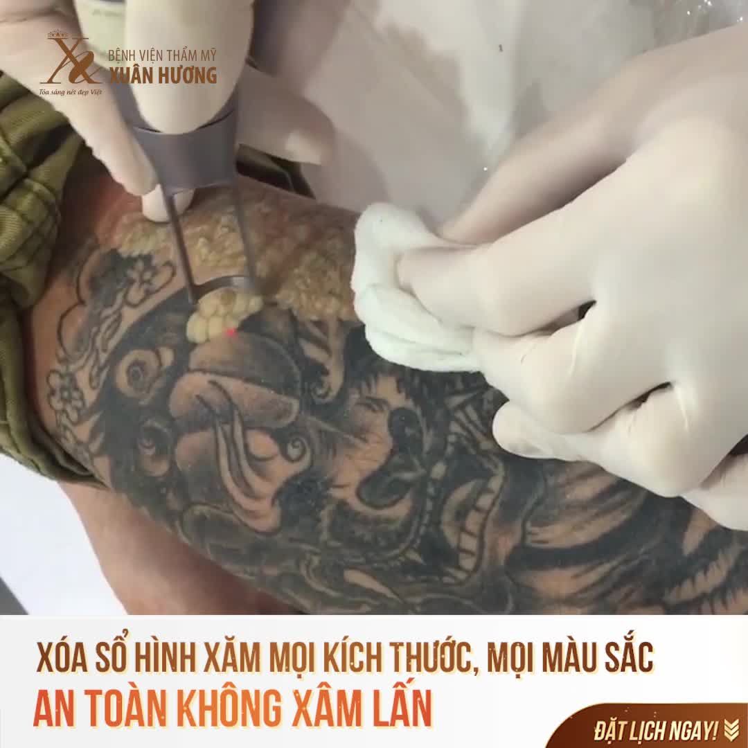 XÓA XĂM AN TOÀN KHÔNG BIẾN CHỨNG CÙNG CÔNG NGHỆ HÀNG ĐẦU THẾ GIỚI
