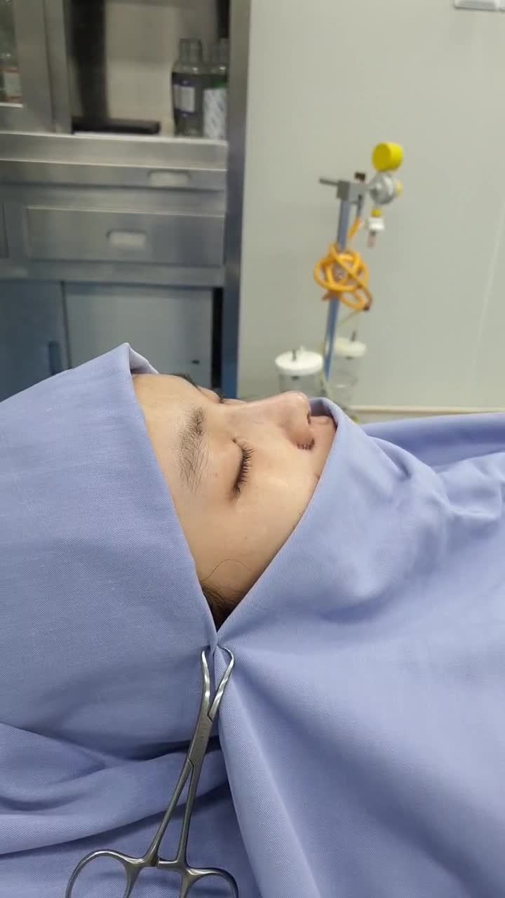 Siêu phẩm mũi sụn sườn 100% vừa mới phẫu thuật tại Kangnam Sài Gòn